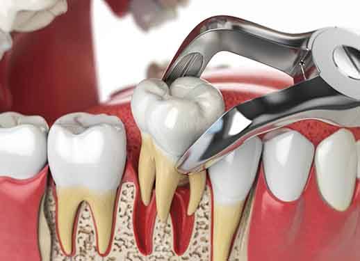 Illustration of a tooth being removed