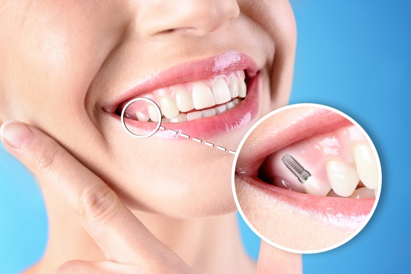 A closeup of a smiling woman with a dental implant